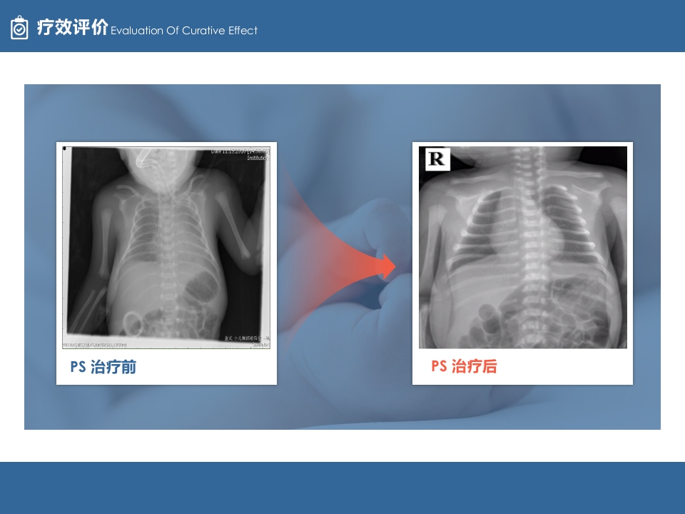 1例VLBW患儿临床病例分享PPT案例模板6
